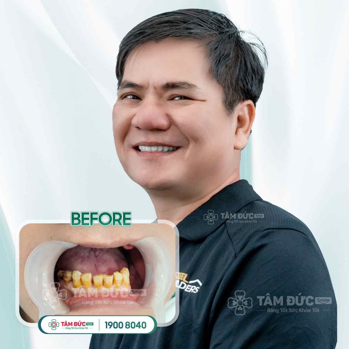 khách hàng trước khi bọc răng sứ điều trị viêm lợi tại nha khoa tâm đức smile