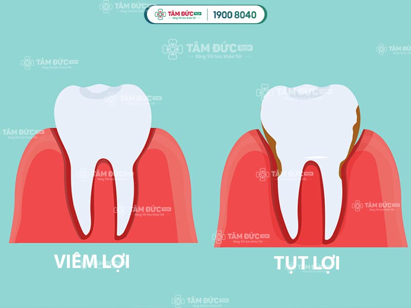 viêm lợi là gì