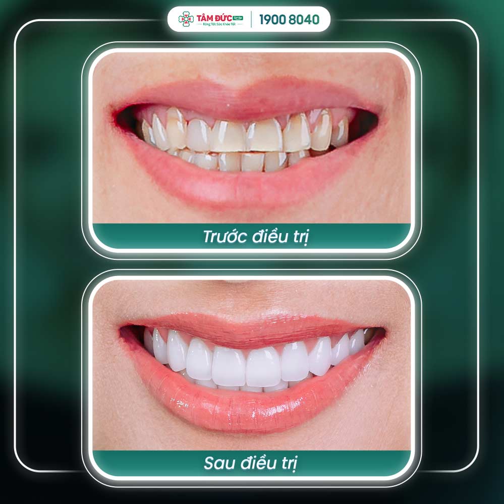 khách hàng điều trị viêm lợi tại nha khoa tâm đức smile