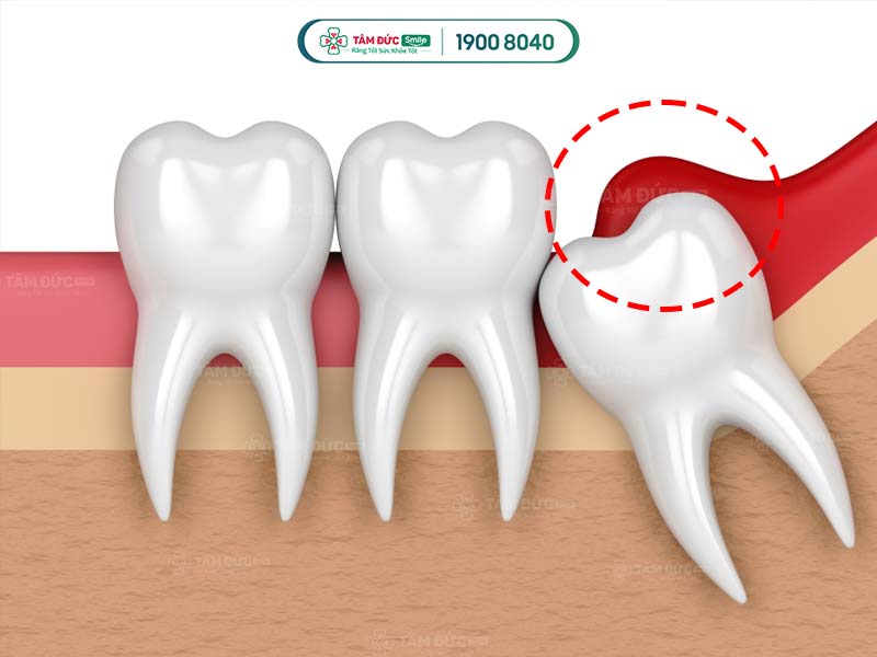 viêm lợi răng khôn có tự hết không