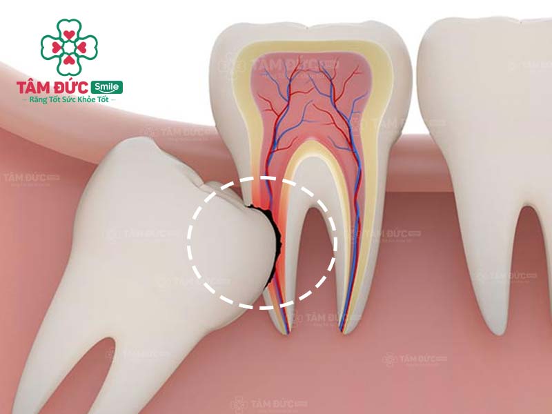 răng khôn mọc lệch đâm vào răng hàm kế cận