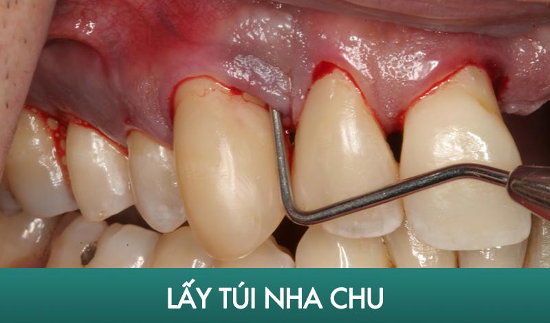 cách điều trị viêm nha chu