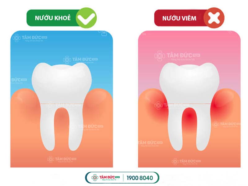 nướu khoẻ mạnh và nướu bị viêm