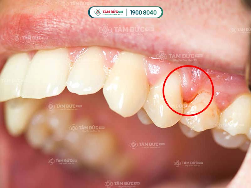 nướu bị viêm sưng đỏ và làm chảy máu chân răng