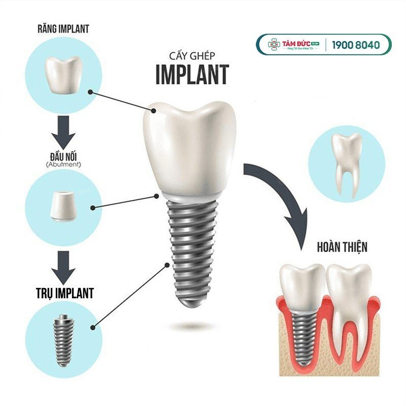 việt kiều về nước làm răng