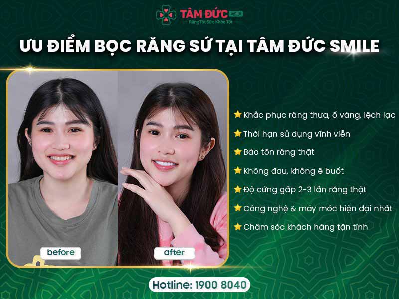 ưu đãi bọc răng sứ cho việt kiều về nước làm răng