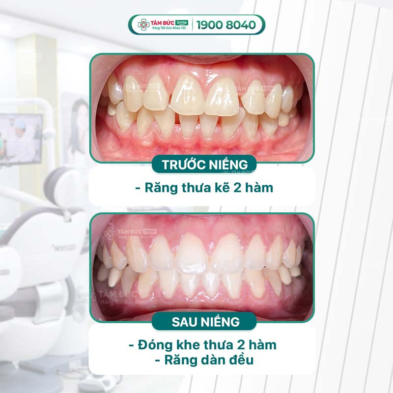 Khách hàng tin tưởng lựa chọn niềng răng tại Tâm Đức Smile