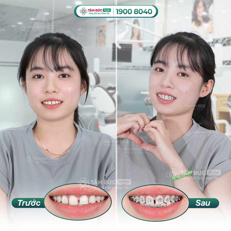 khách hàng điều trị răng thưa tại nha khoa Tâm Đức Smile