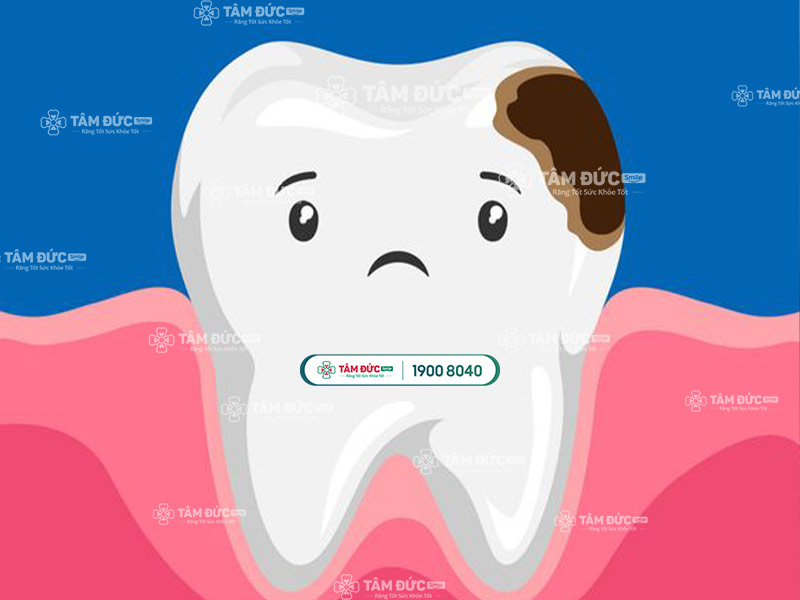 răng đổi màu khi bị xiết ăn