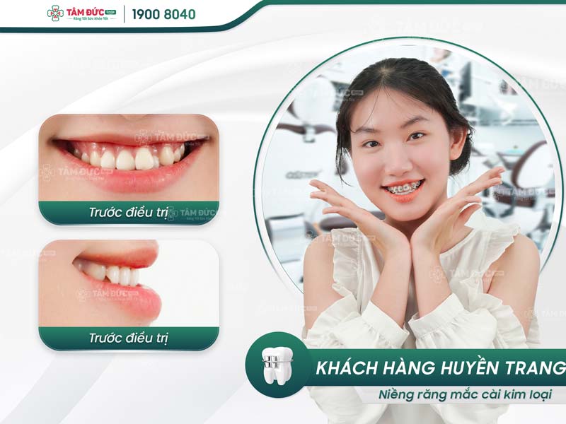 khách hàng niềng răng tại nha khoa Tâm Đức Smile