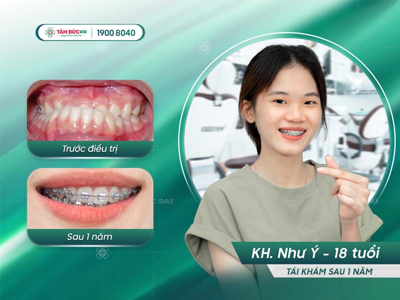 khách hàng niềng răng móm tại nha khoa Tâm Đức Smile