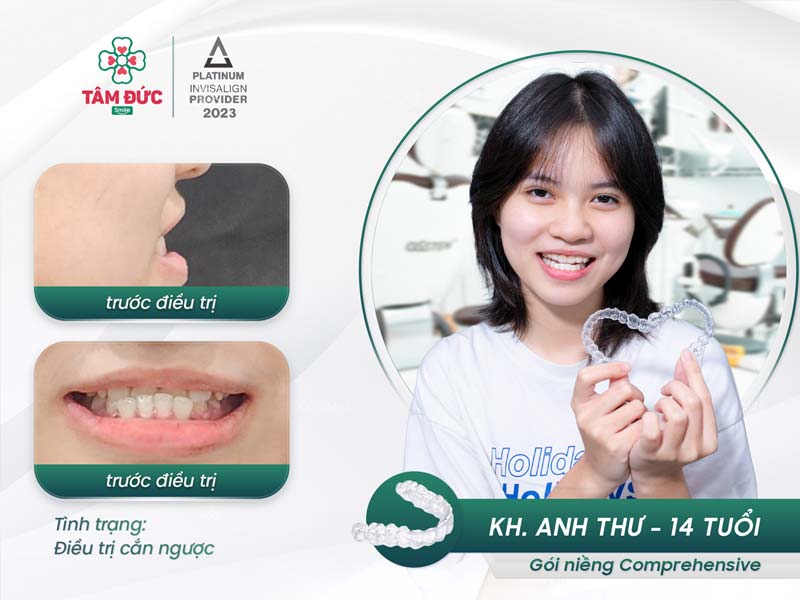 khách hàng niềng răng móm tại nha khoa Tâm Đức Smile