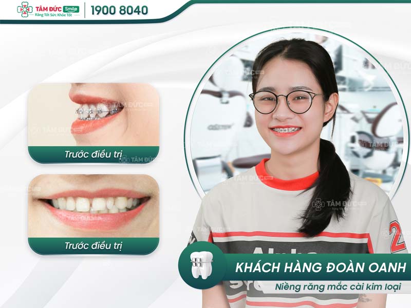 khách hàng niềng răng tại nha khoa Tâm Đức Smile