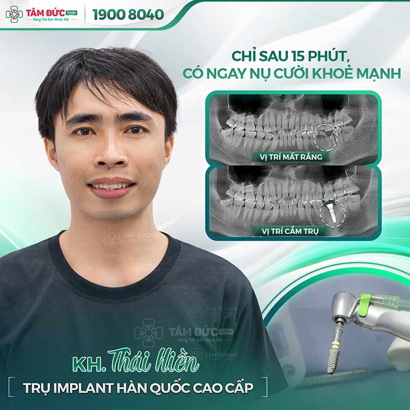 địa chỉ trồng răng uy tín tại quận 9