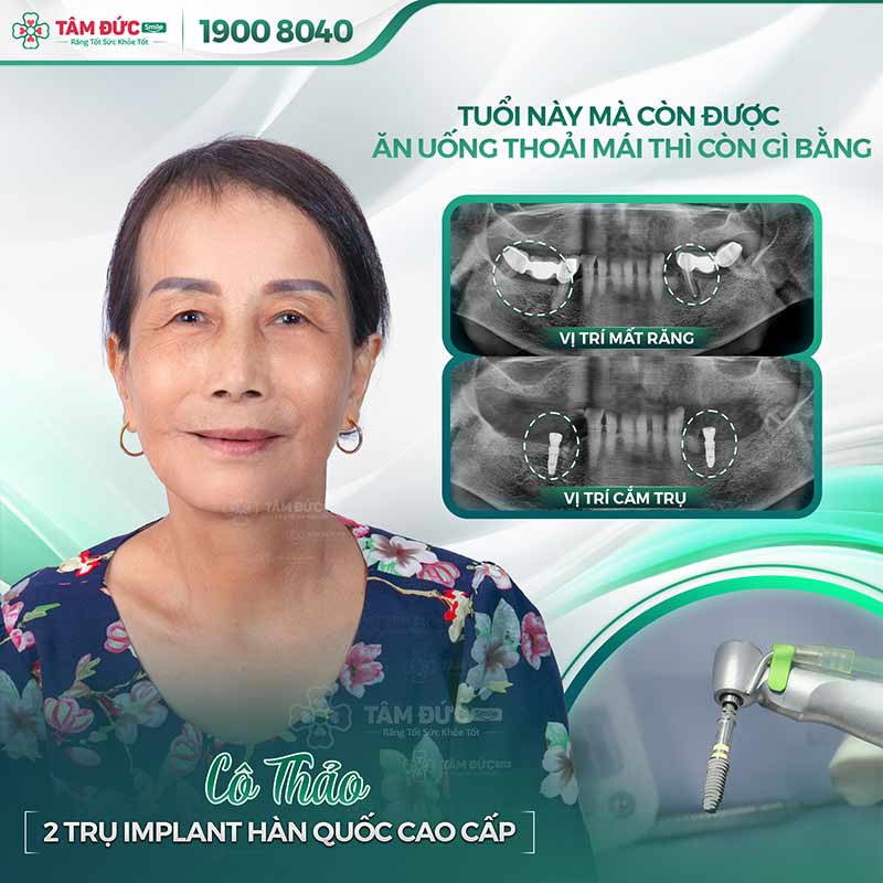 địa chỉ trồng răng uy tín tại quận 9