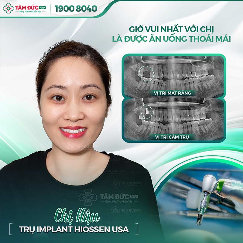 địa chỉ trồng răng uy tín tại quận 9