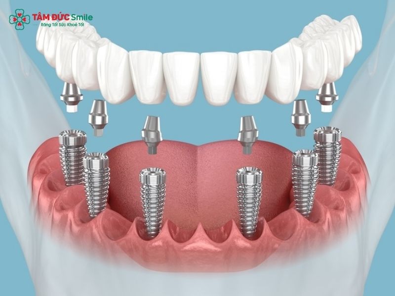 3-on-6-dental-implants-1