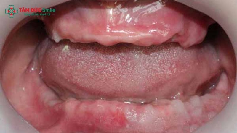 3-on-6-dental-implants-4