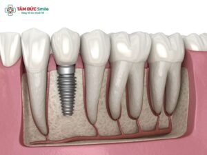 advantages-of-dental-implants-1