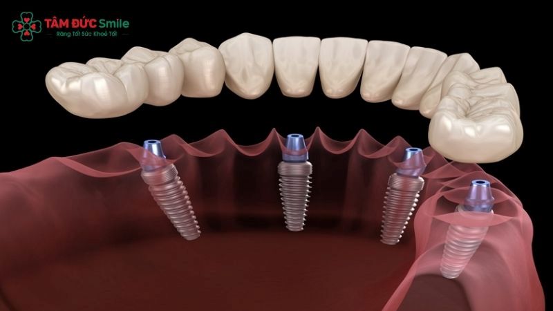 all-on-4-implant-1