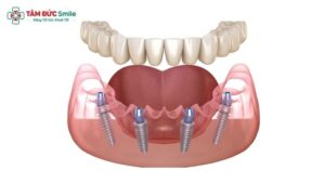 all-on-4-implant-2