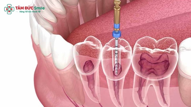 alternative-to-tooth-implant-3