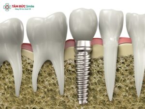 are-dental-implants-painful-1