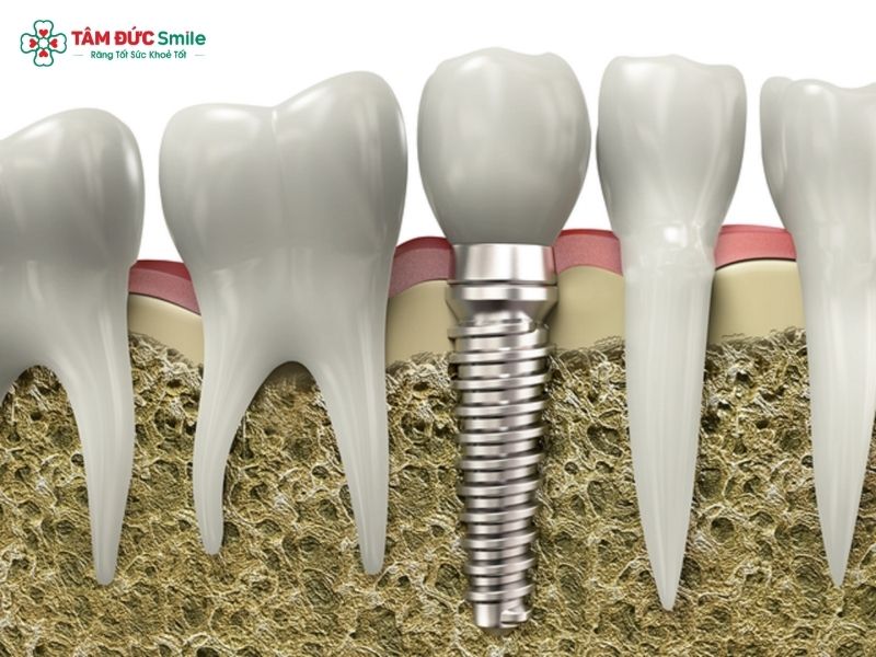 are-dental-implants-painful-1