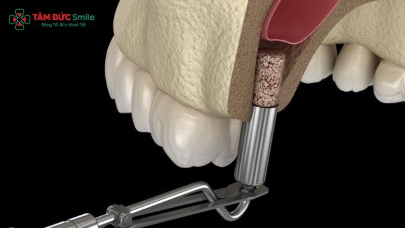 are-dental-implants-painful-3