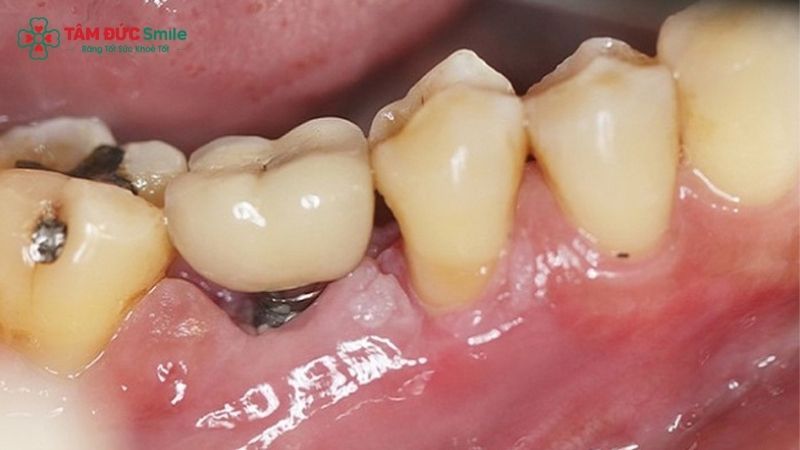 are-dental-implants-safe-2