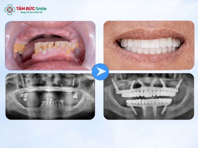 are-dental-implants-safe-4