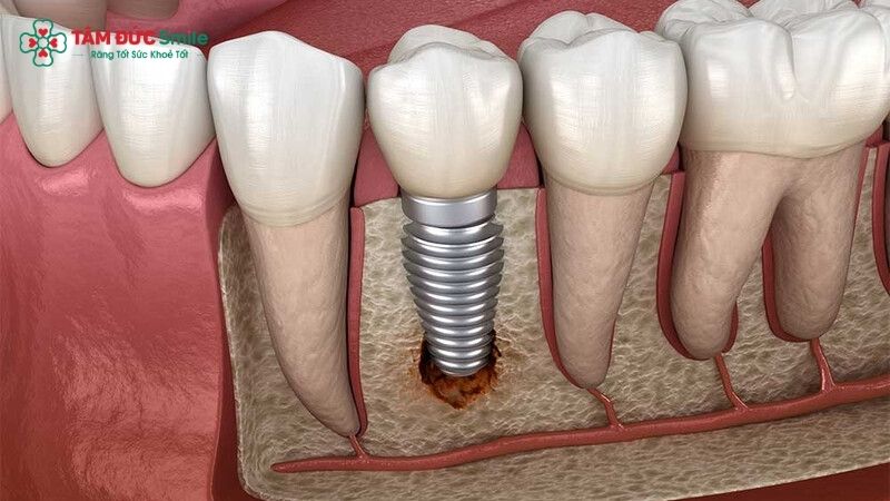 bad-dental-implants-1