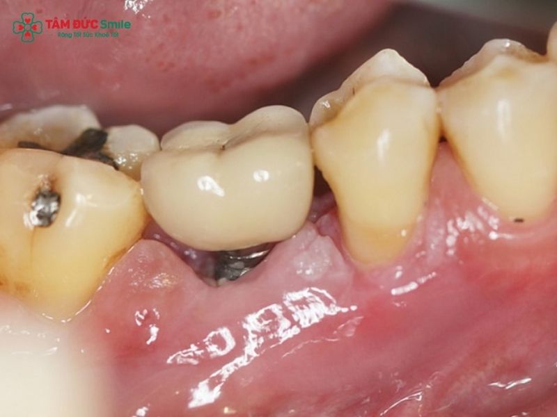 bad-dental-implants-2