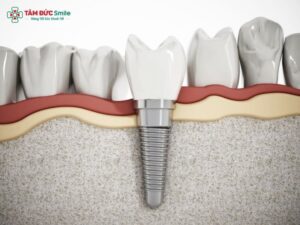 benefits-of-dental-implants-2