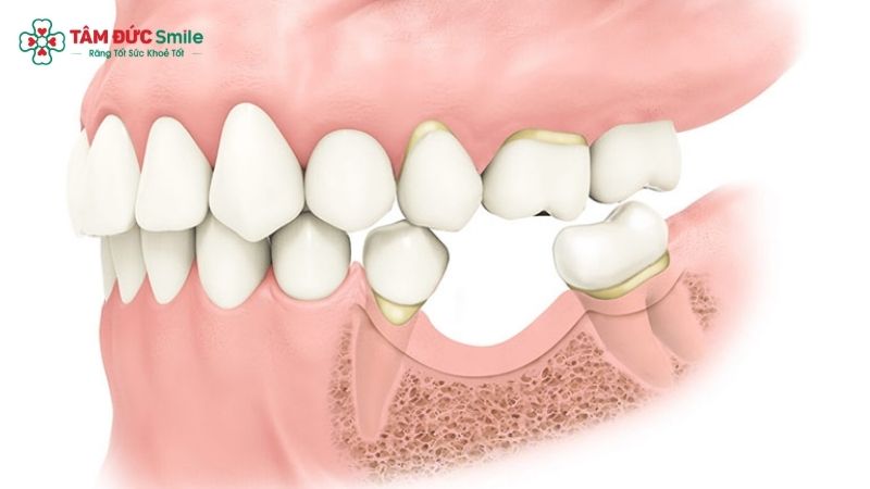 bone-graft-for-dental-implant-1