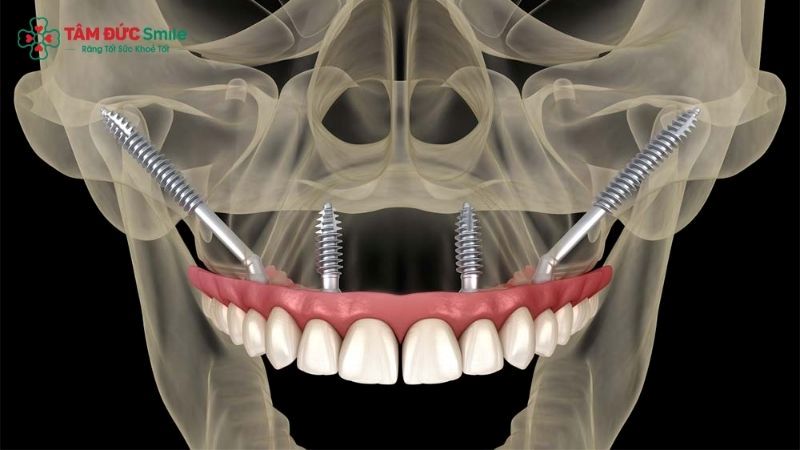 can-you-get-dental-implants-with-bone-loss-1
