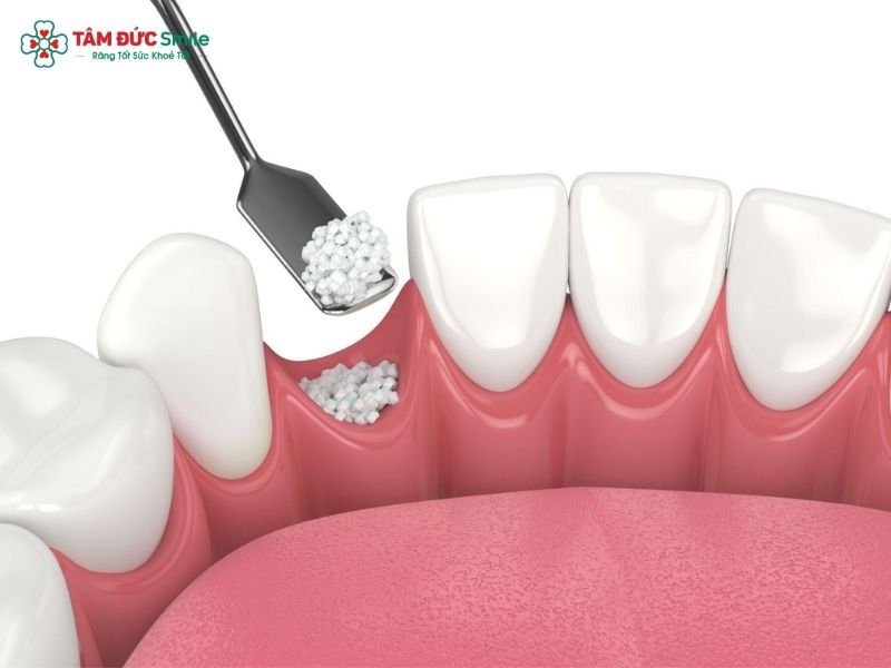 can-you-get-dental-implants-with-bone-loss-2