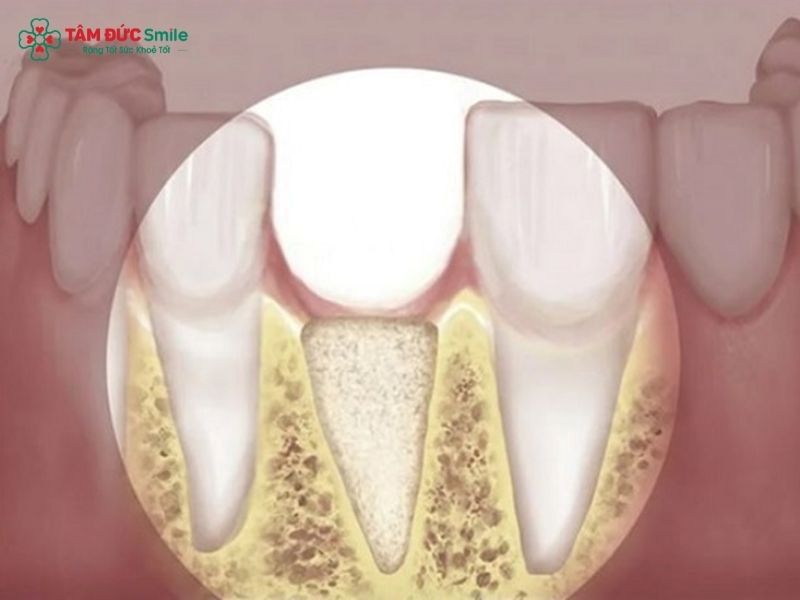can-you-get-dental-implants-with-bone-loss-3