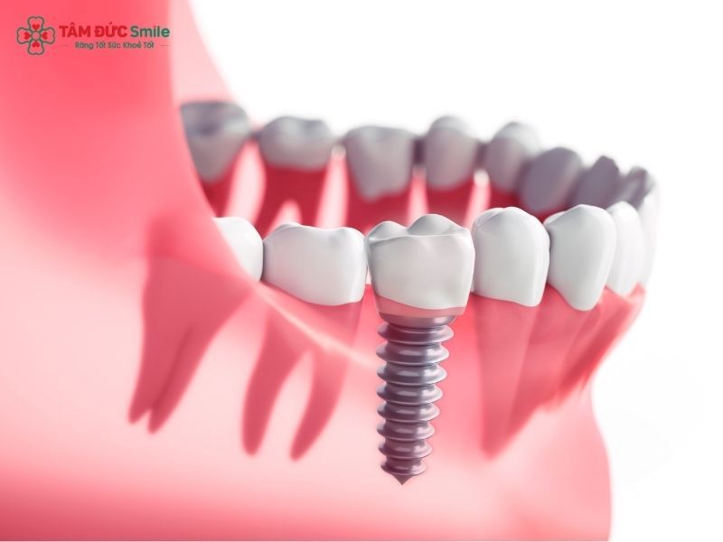 can-you-get-dental-implants-with-bone-loss-4