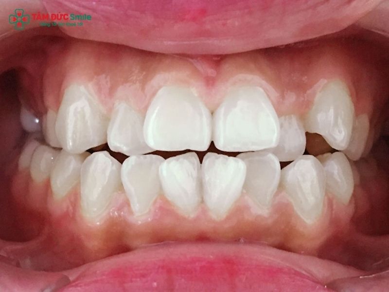clear-aligners-3