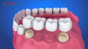 dental-implant-bridge-1