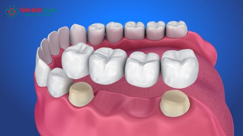 dental-implant-bridge-1