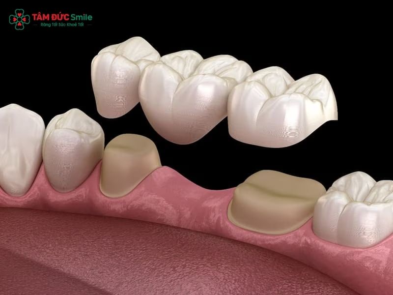dental-implant-bridge-2