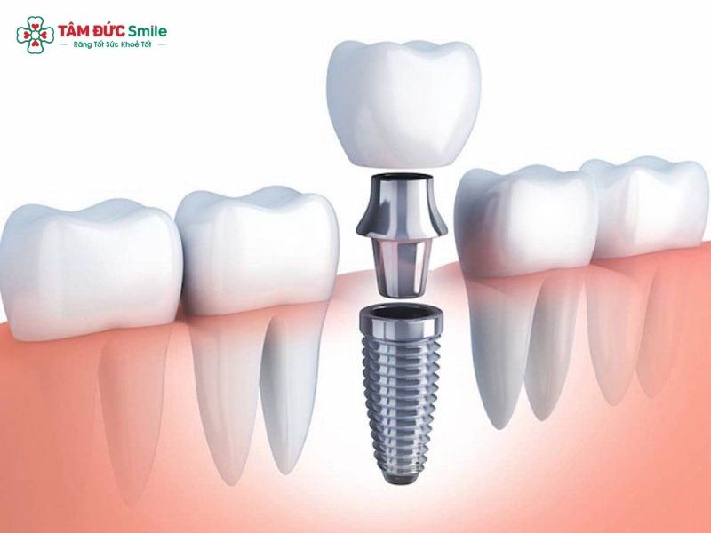 dental-implant-components-3