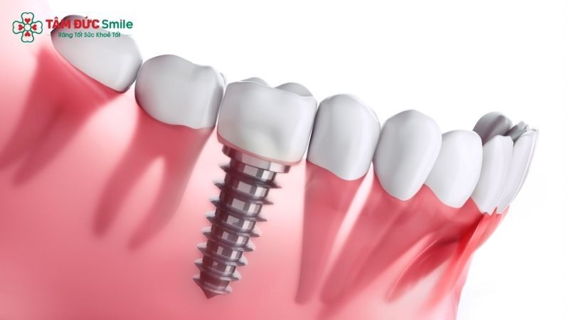 dental-implant-cost-3