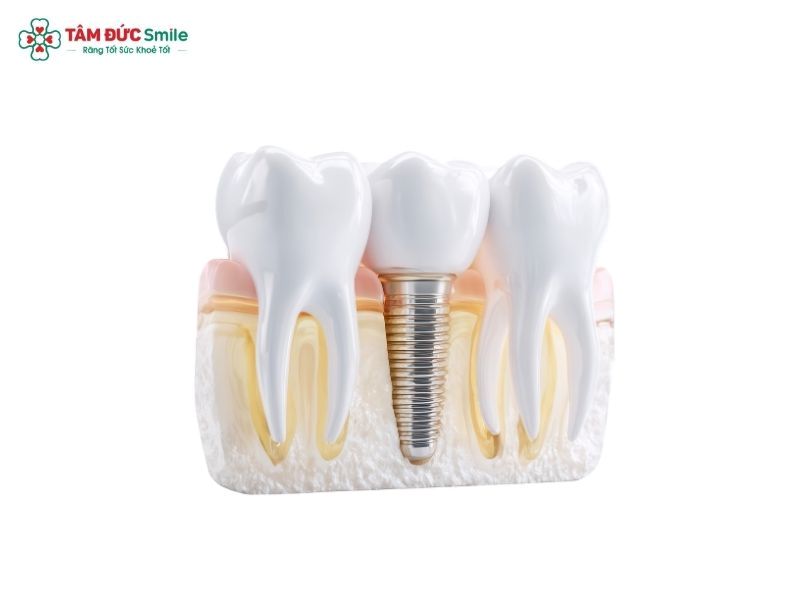 dental-implants-4