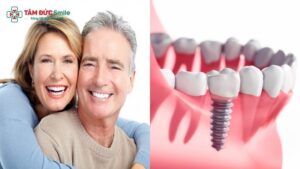 dental-implants-for-seniors-3