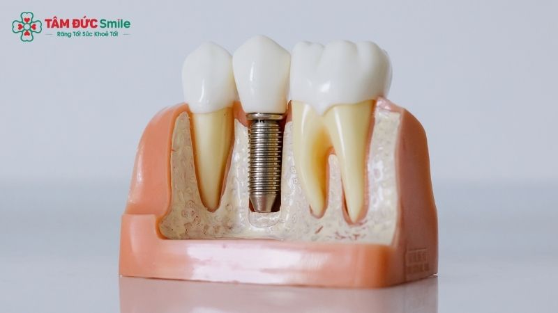 dental-implants-vietnam-1