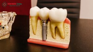 disadvantages-of-dental-implants-1
