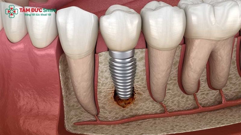 disadvantages-of-dental-implants-2